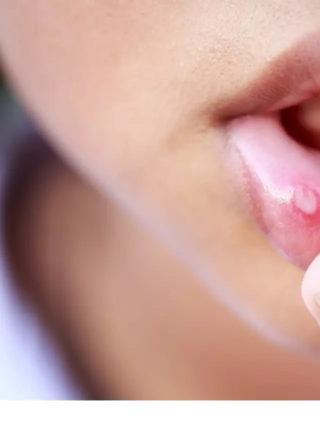   Giải pháp cho chứng viêm nhiệt miệng